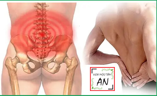 Đau vùng mông gần xương cụt