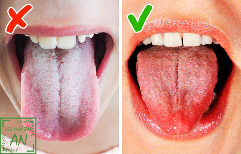 Lưỡi đóng trắng là biểu hiện của bệnh lý