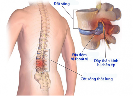 Đau lưng ảnh hưởng tới đời sống sinh hoạt hàng ngày và có thể bị teo cơ chân,...