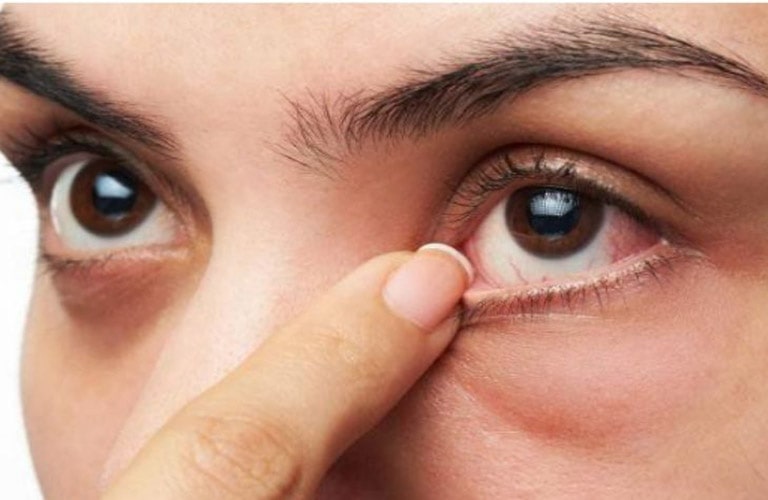 Bấm huyệt tinh minh - hệ thống các huyệt quanh vùng mắt