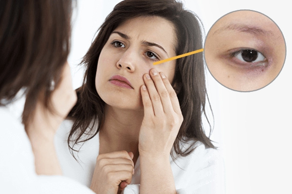 Thiếu ngủ và thức khuya là những nguyên nhân làm cho vùng da dưới mắt bị thâm