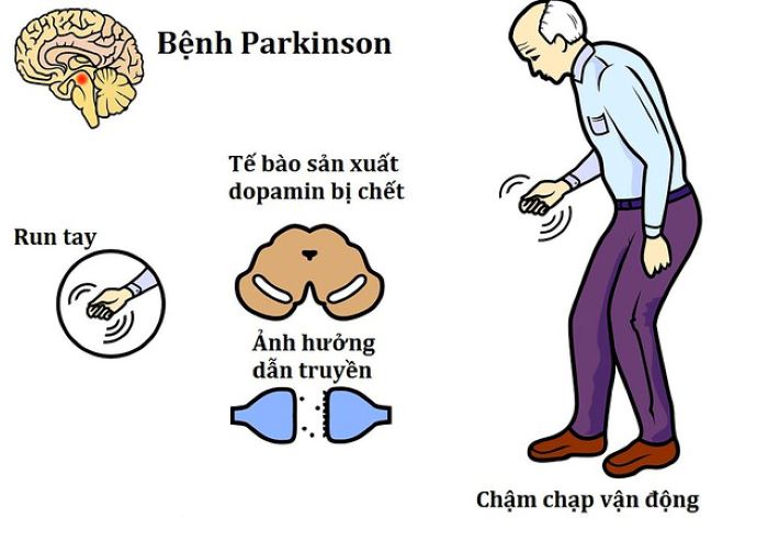 Bệnh Parkinson là căn bệnh phổ biến ở người già