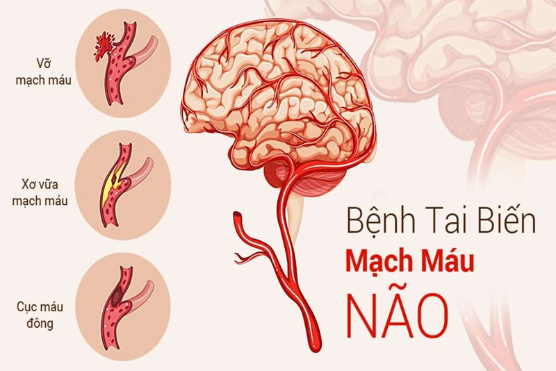 Túc dưỡng tâm thang giúp hạn chế tai biến mạch máu não