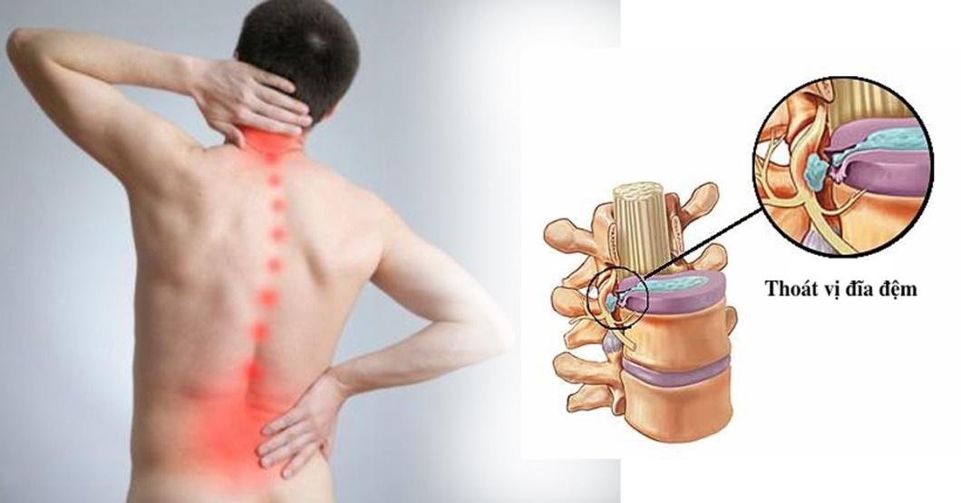 Thoát vị đĩa đệm là một trong những nguyên nhân gây đau thắt lưng 