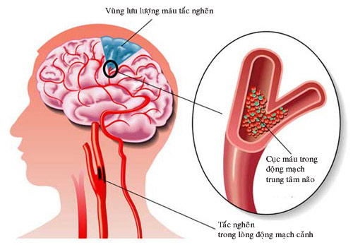 Thiếu máu não là nguyên nhân sâu xa gây mất trí nhớ ở người già