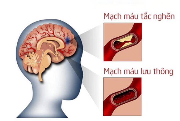 Tắc nghẽn động mạch não khiến não thiếu máu cục bộ gây mất trí  nhớ