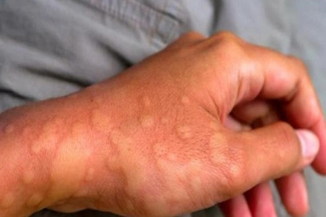 Da nổi mẩn đỏ kèm theo ngứa ngáy khó chịu là triệu chứng điển hình khi bị nóng gan