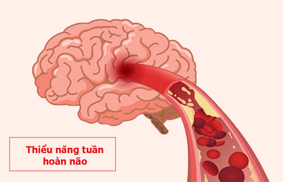 Thiểu năng tuần hoàn não là biến chứng nghiêm trọng của tình trạng đau vai gáy
