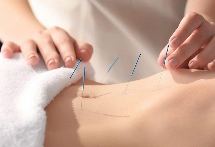 Châm cứu là 1 trong 2 phương pháp cơ bản tác động vào huyệt Khí Hải khi trị liệu